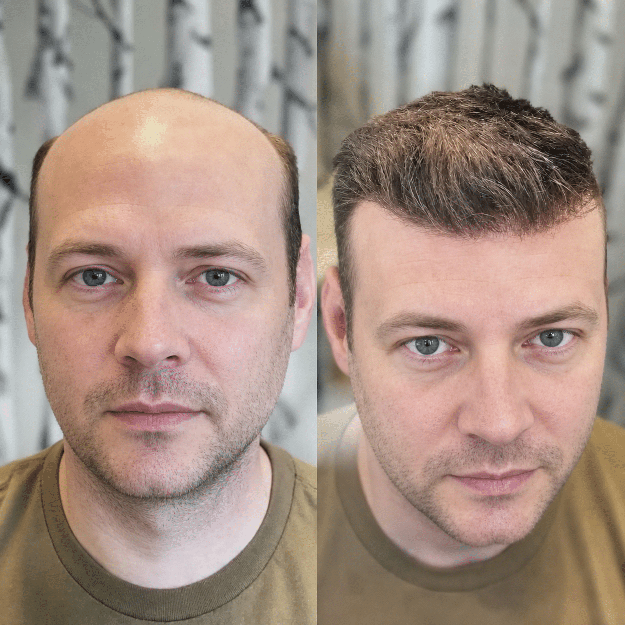 Before and after men’s hair system transformation